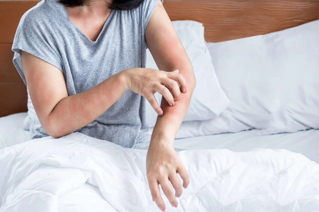 020_niet slapen door jeuk niet slapen door jeuk